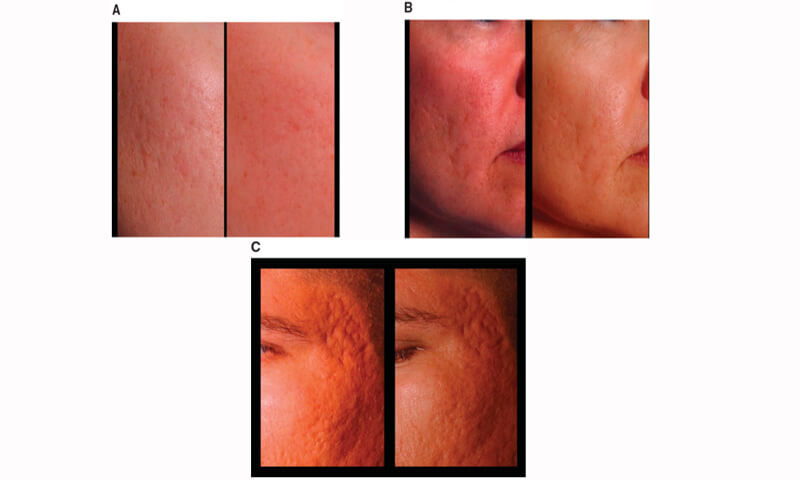 treatment of acne 